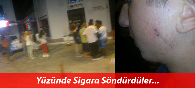 Yüzünde Sigara Söndürdüler