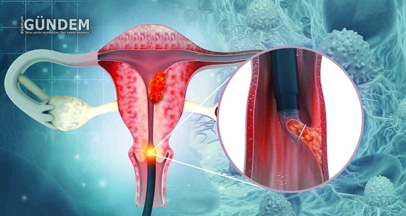 Ocak Ayı Rahim Ağzı (Serviks) Kanseri Farkındalık Ayı