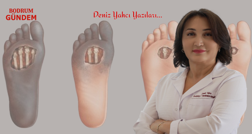 Diyabetik Ayak’ta Her 20 Saniyede Bir Kayıp Yaşanıyor
